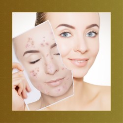 Face - IMPURE SKIN AND ACNE